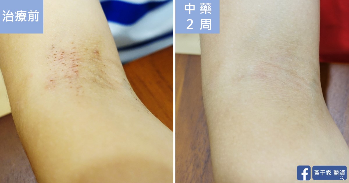 同一位小患者右手肘內側的近照比對，左標示「治療前」，可見抓痕紅疹；右標示「中藥 2 周」