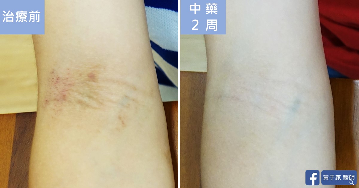 同一位小患者手肘內側另一角度的近照比對，左標示「治療前」，右標示「中藥 2 周」
