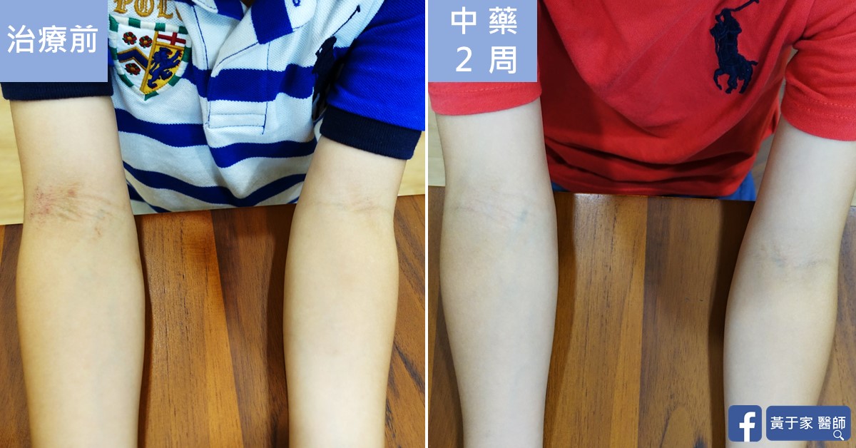 同一位小患者雙前臂與肘窩的比對，左標示「治療前」，右標示「中藥 2 周」