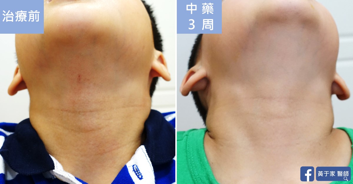 同一位小患者仰頭時頸部的比對，左標示「治療前」，右標示「中藥 3 周」