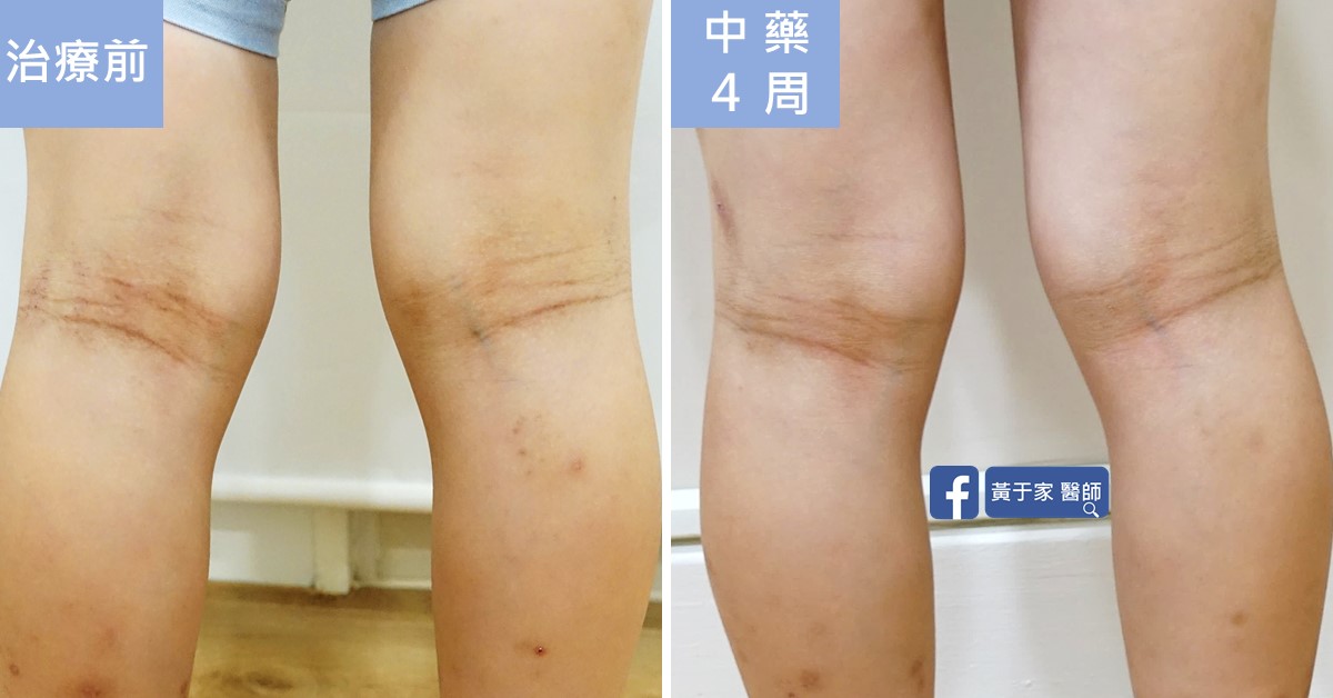 同一位小患者雙膝後側膝窩的比對，左標示「治療前」，右標示「中藥 4 周」