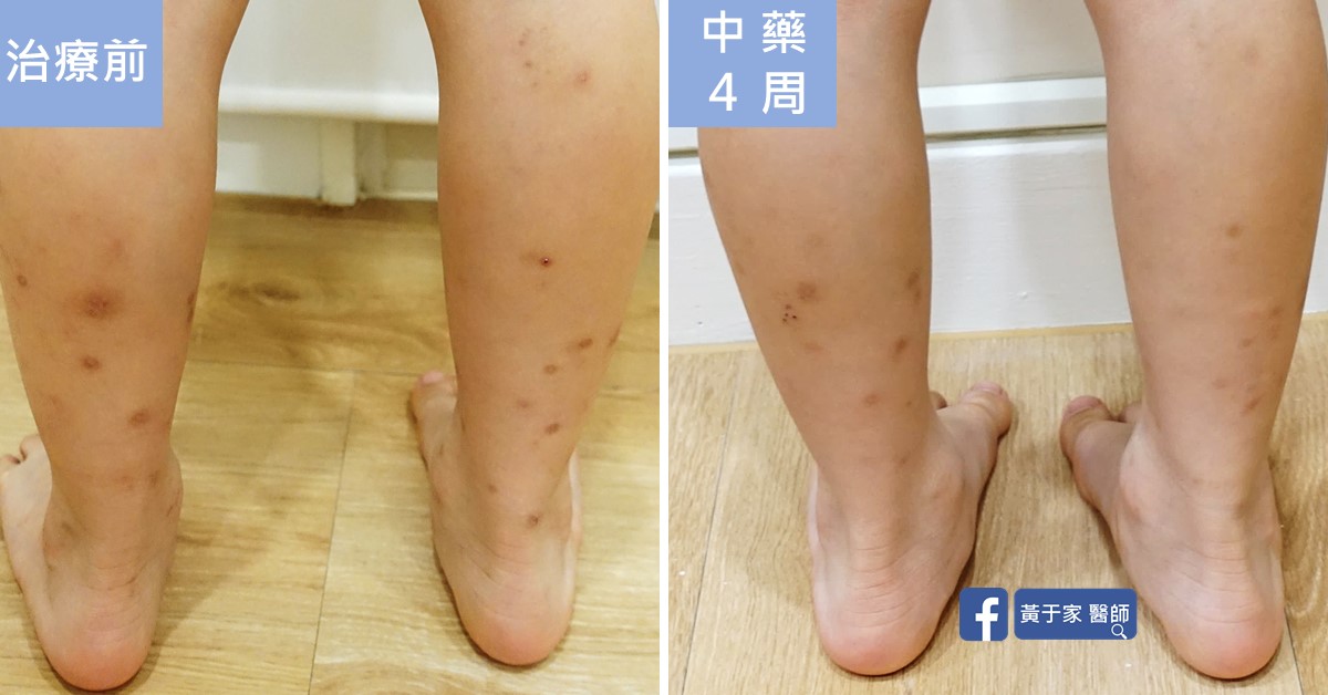 同一位小患者雙小腿後側的比對，左標示「治療前」，可見多處搔抓疤痕；右標示「中藥 4 周」，疤痕變淡