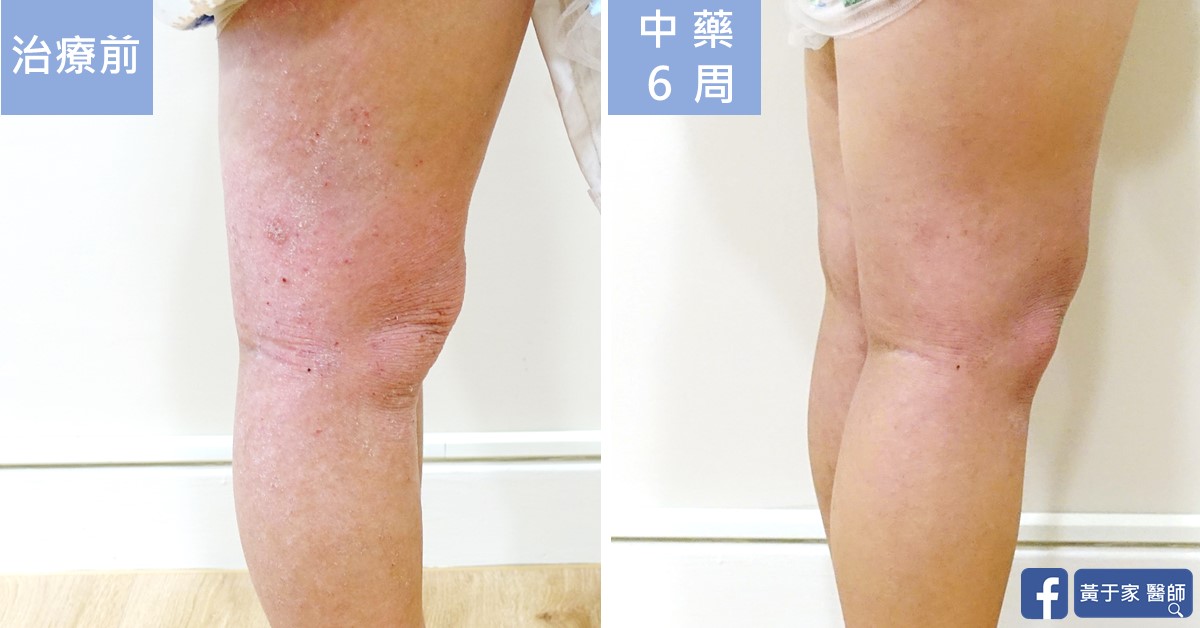 同一位小患者腿部後側與膝窩的比對,左標示「治療前」,右標示「中藥 6 周」