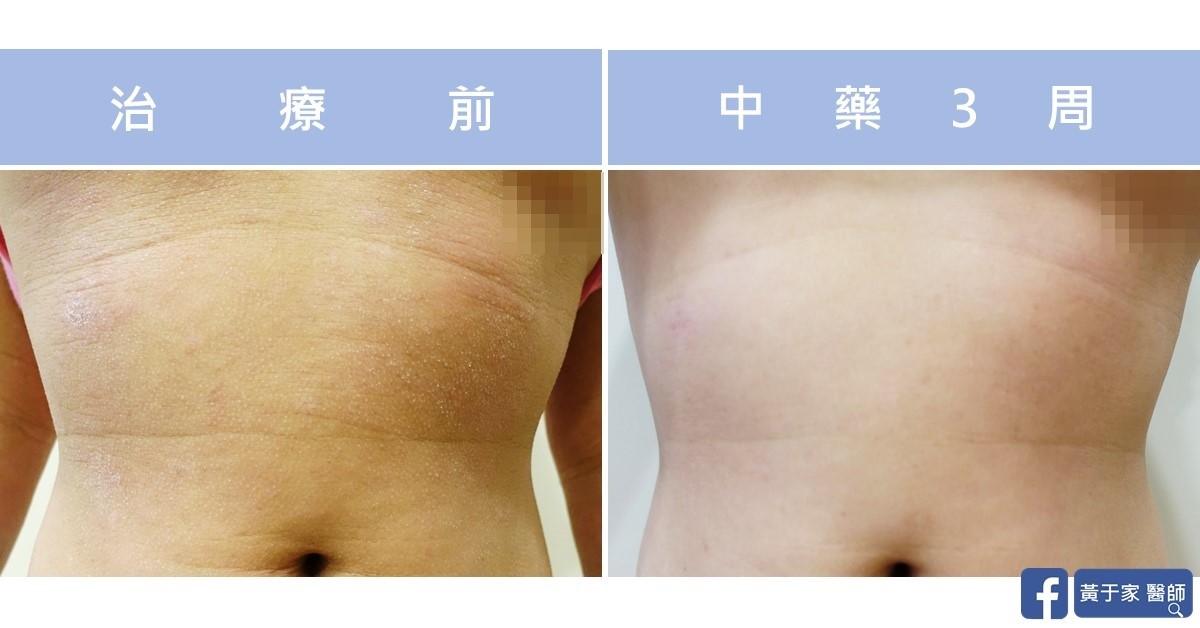 同一位小患者腹部與胸下的比對,左標示「治療前」,右標示「中藥 3 周」