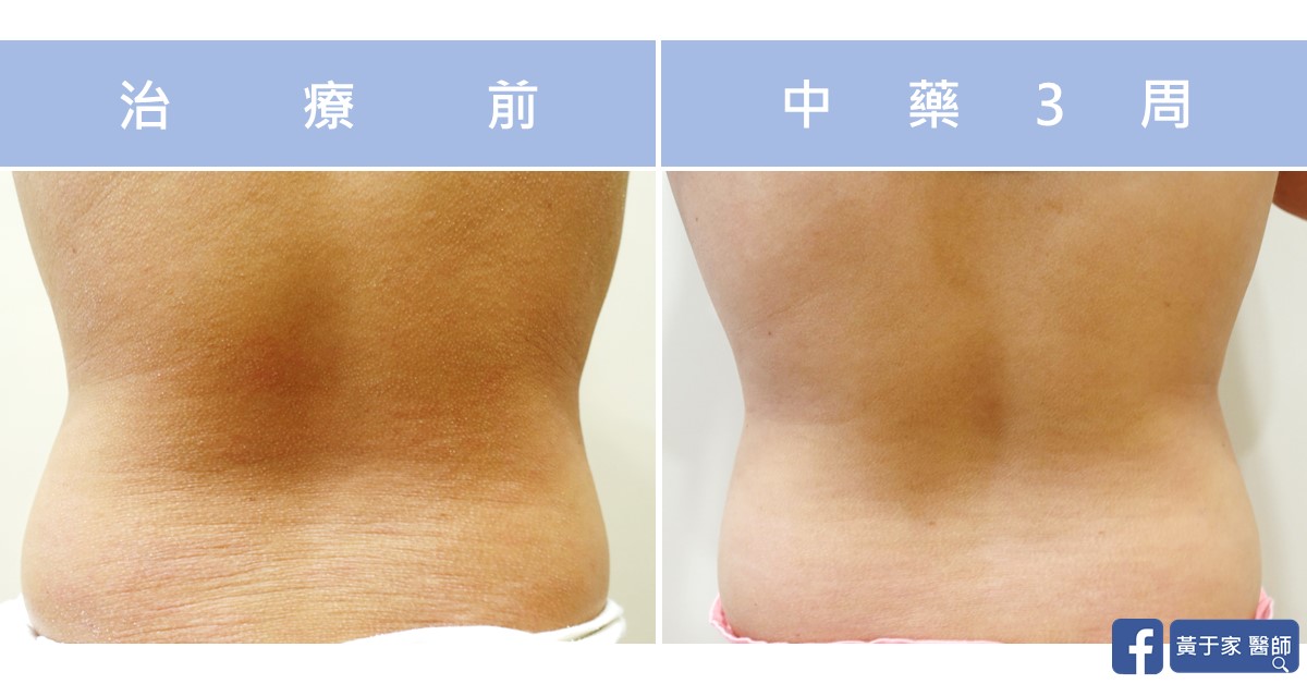 同一位小患者下背部的比對,左標示「治療前」,可見橫向擴張紋;右標示「中藥 3 周」