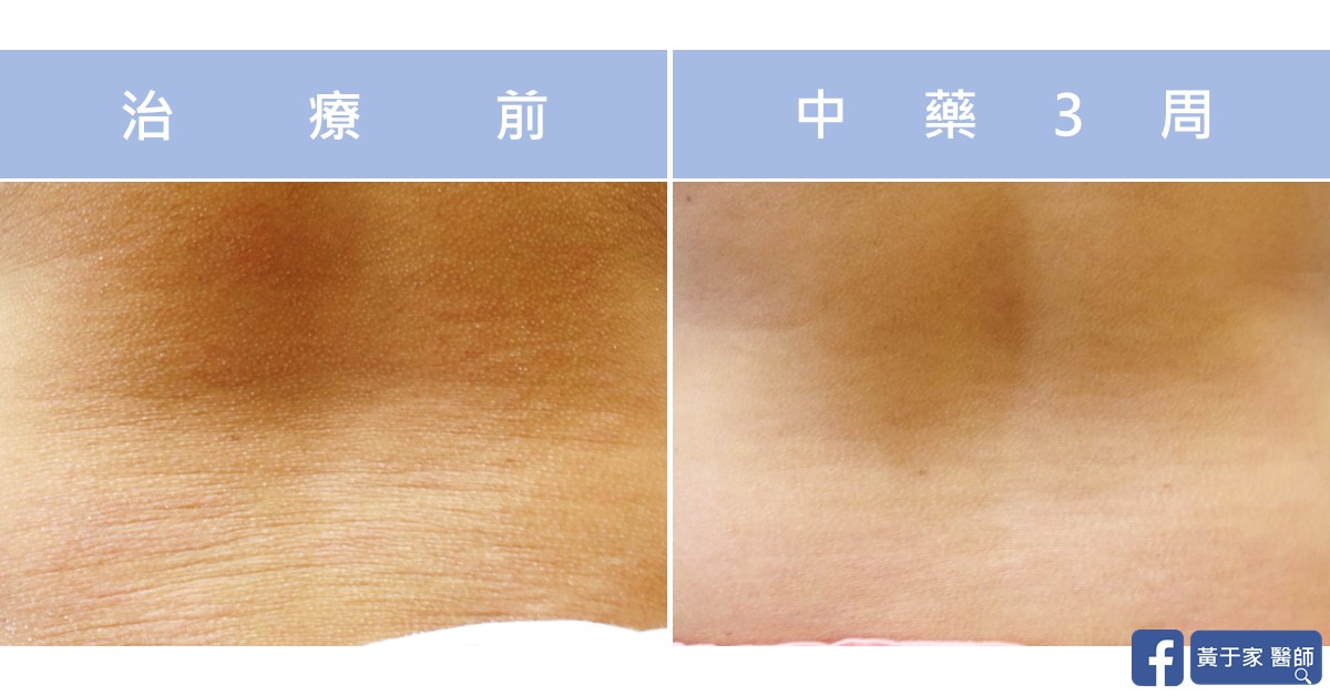 同一位小患者下背部擴張紋的近照比對,左標示「治療前」,右標示「中藥 3 周」