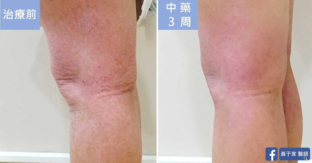 同一位小患者膝蓋側面的比對,左標示「治療前」,右標示「中藥 3 周」