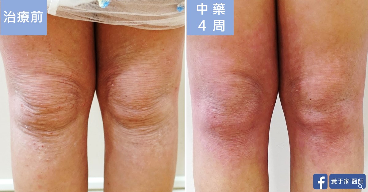 同一位小患者雙膝正面的比對,左標示「治療前」,膝部皮膚皺縮脫屑;右標示「中藥 4 周」