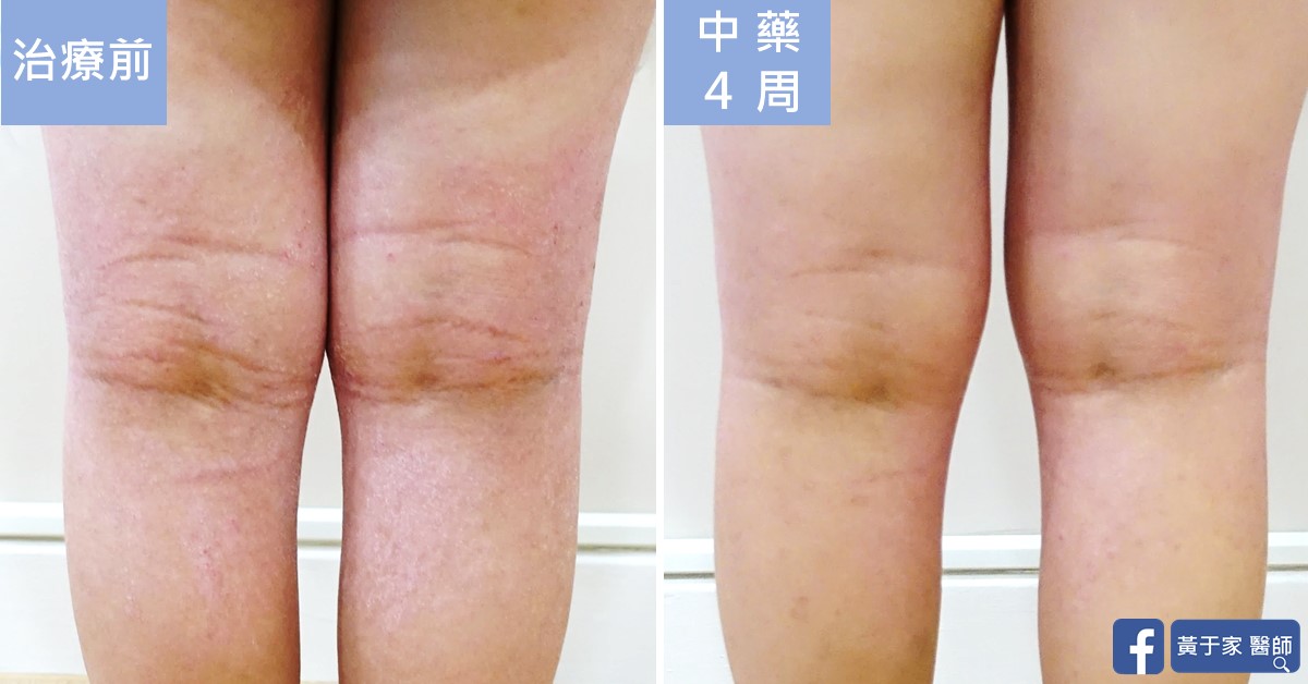 同一位小患者雙膝後側膝窩的比對,左標示「治療前」,右標示「中藥 4 周」