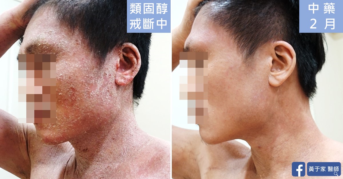 同一位男性患者左側臉與頸部的比對,左標示「類固醇戒斷中」,滿布脫屑;右標示「中藥 2 月」