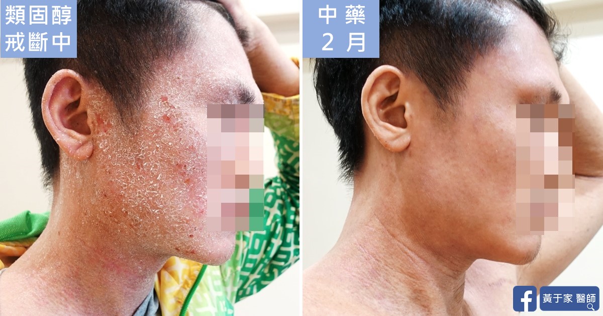 同一位患者右側臉與頸部的比對,左標示「類固醇戒斷中」,右標示「中藥 2 月」