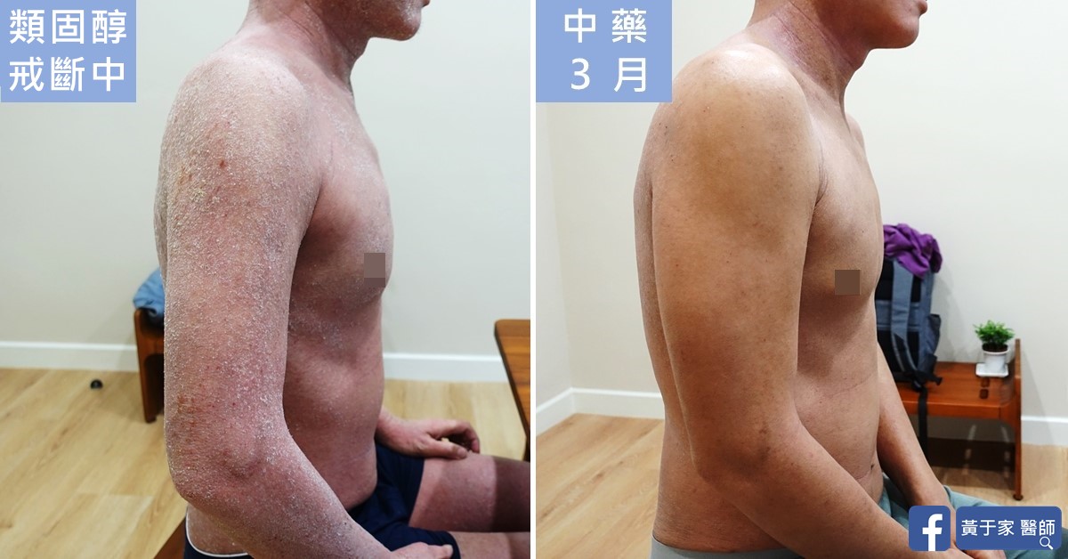 同一位患者坐姿右側上身的比對,左標示「類固醇戒斷中」,右標示「中藥 3 月」