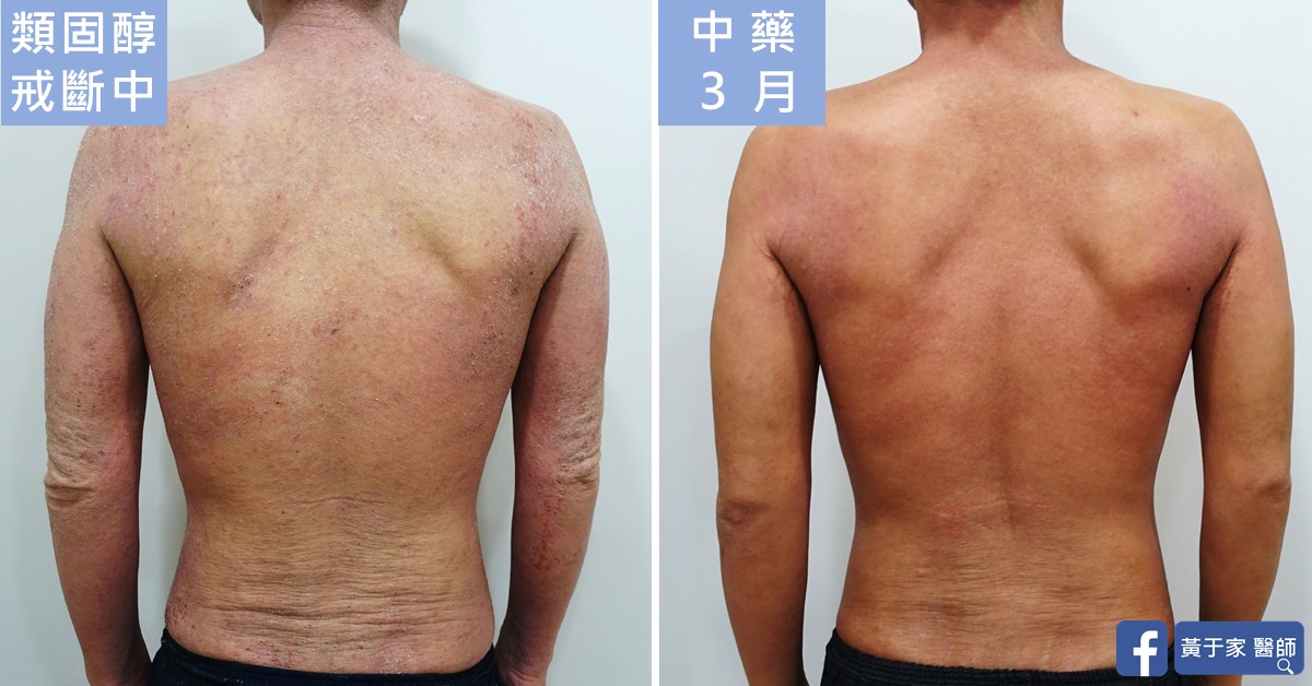 同一位患者背部的比對,左標示「類固醇戒斷中」,右標示「中藥 3 月」