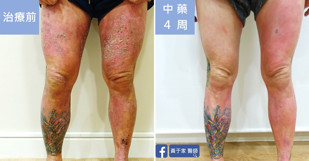 慢性蕁麻疹患者治療前後皮膚外觀比對