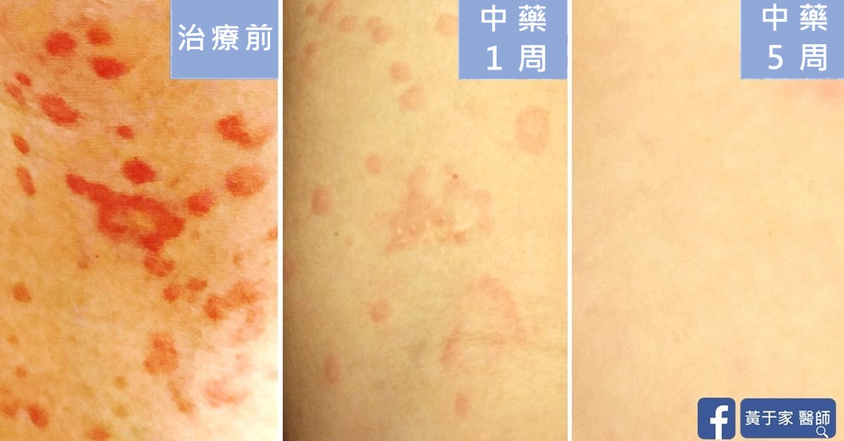 同一處皮膚的蕁麻疹特寫,依序標示「治療前」「中藥 1 周」「中藥 5 周」