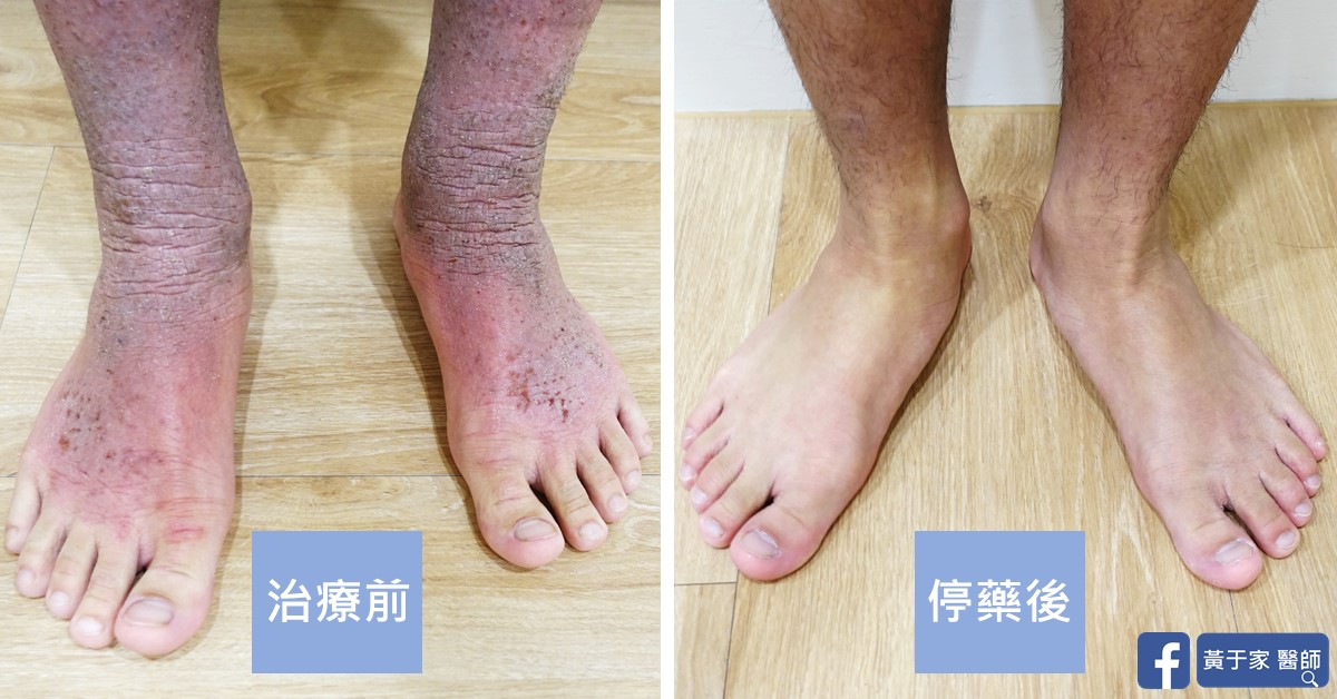 類固醇戒斷患者治療前後皮膚外觀比對（1）