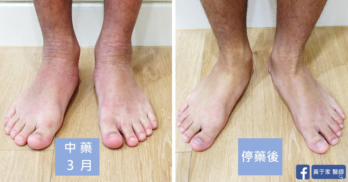 類固醇戒斷患者治療前後皮膚外觀比對（2）