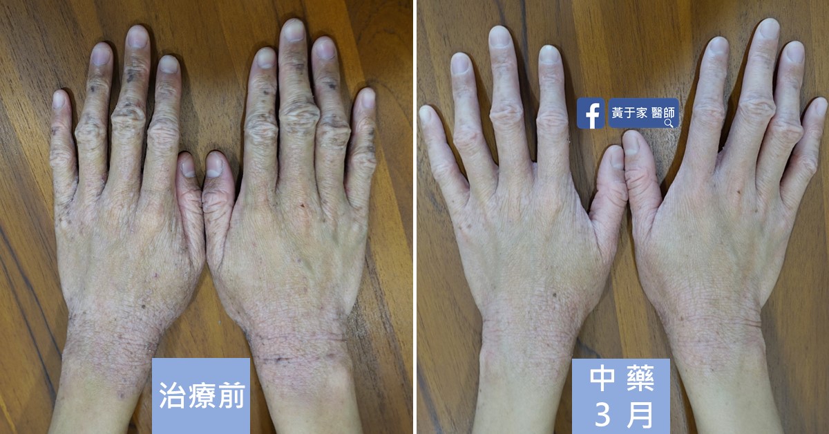 患者皮膚上反覆搔抓留下的斑點與紋路,治療前後比對