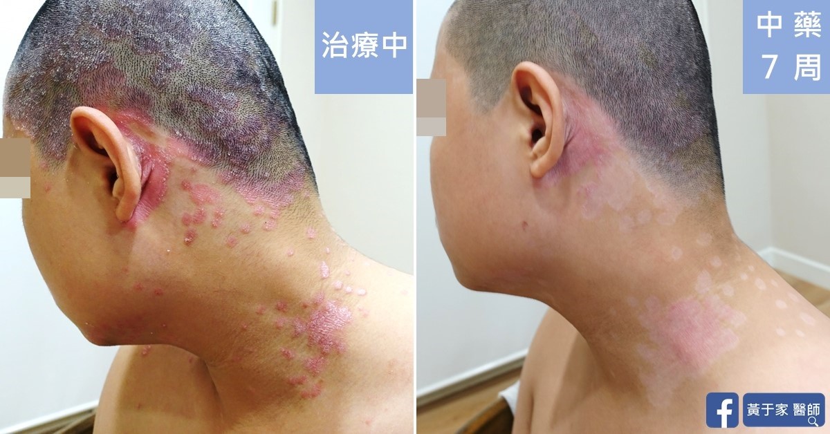 同一位男性患者左耳後與頸部的比對,左標示「治療中」,布滿紅色乾癬斑塊;右標示「中藥 7 周」