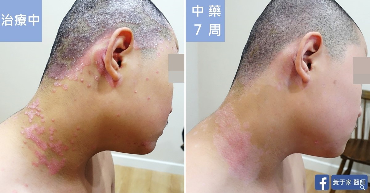同一位患者右耳後與頸部的比對,左標示「治療中」,右標示「中藥 7 周」