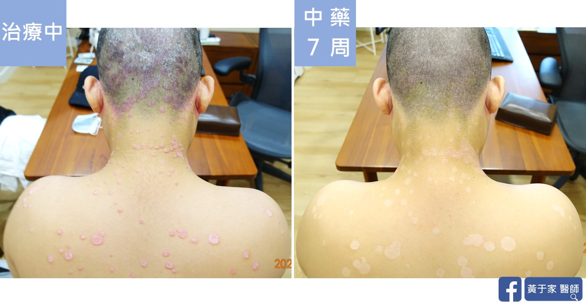 同一位患者後頸與上背部的比對,左標示「治療中」,散布紅色斑塊;右標示「中藥 7 周」