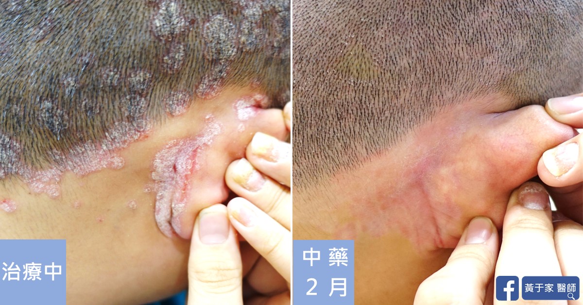 同一位患者左耳後的近照比對,左標示「治療中」,耳後有厚鱗屑斑塊;右標示「中藥 2 月」