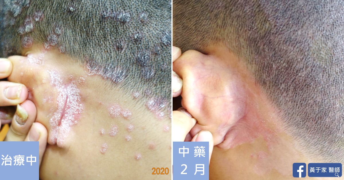 同一位患者右耳後的近照比對,左標示「治療中」,耳後有厚鱗屑斑塊;右標示「中藥 2 月」