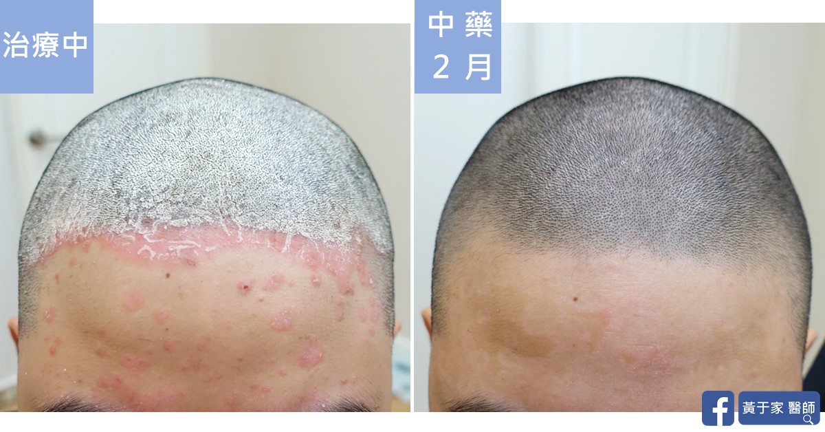 同一位患者額頭與前髮際的比對,左標示「治療中」,髮際布滿鱗屑紅斑;右標示「中藥 2 月」