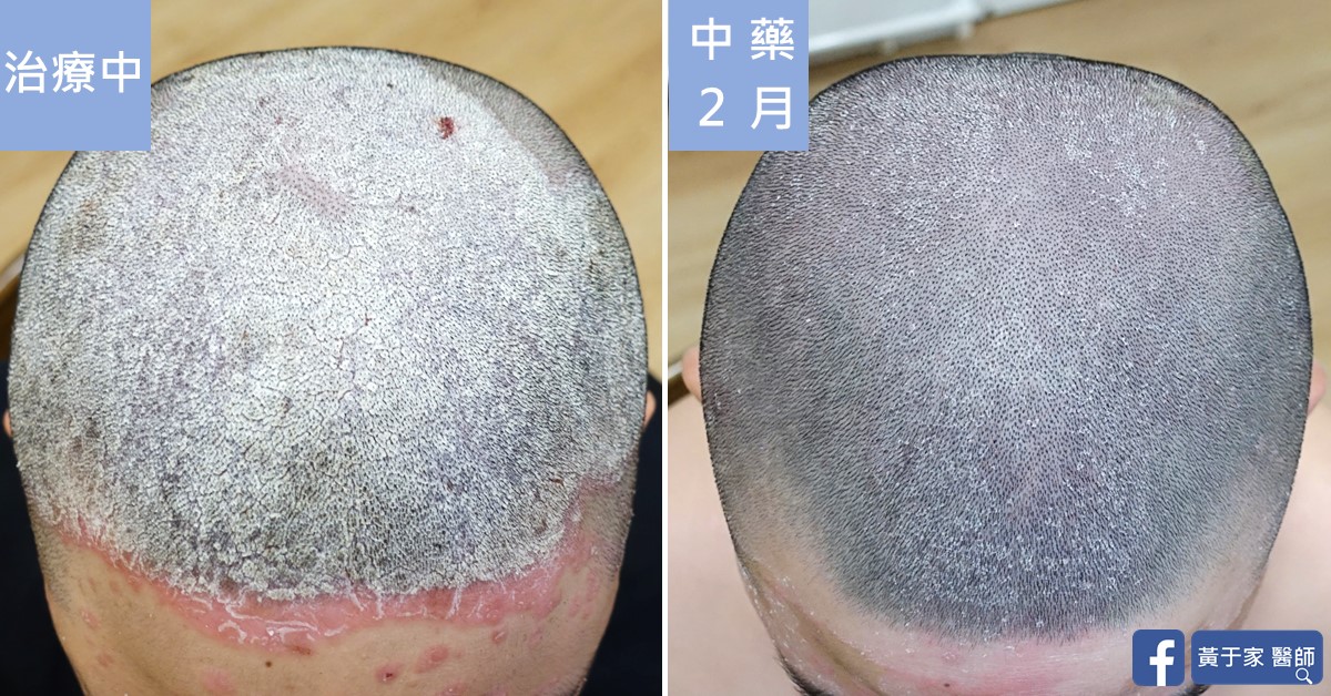 同一位患者頭頂的俯視比對,左標示「治療中」,頭皮滿布白色鱗屑;右標示「中藥 2 月」