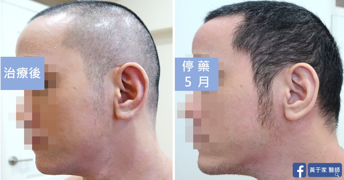 類固醇戒斷患者治療前後皮膚外觀比對（1）