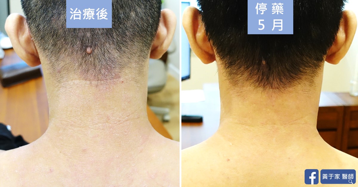 類固醇戒斷患者治療前後皮膚外觀比對（2）