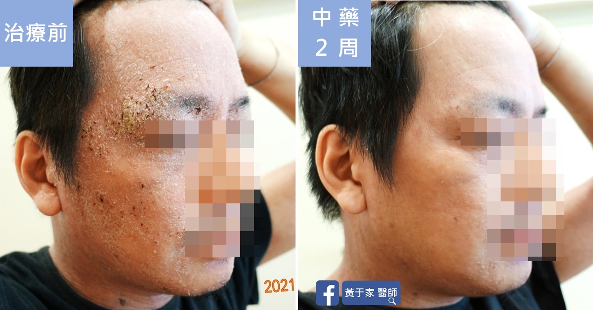 類固醇戒斷患者治療前後皮膚外觀比對（1）