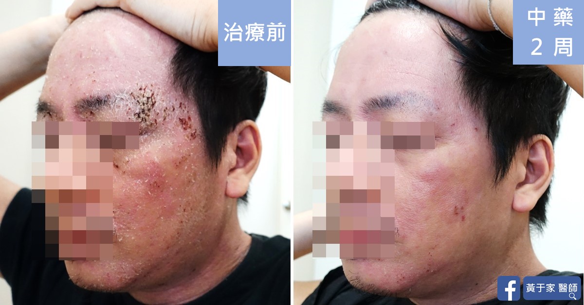 類固醇戒斷患者治療前後皮膚外觀比對（2）