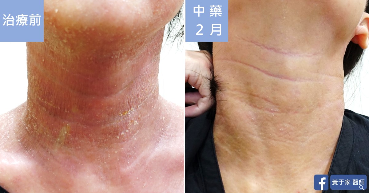 類固醇戒斷患者治療前後皮膚外觀比對（1）