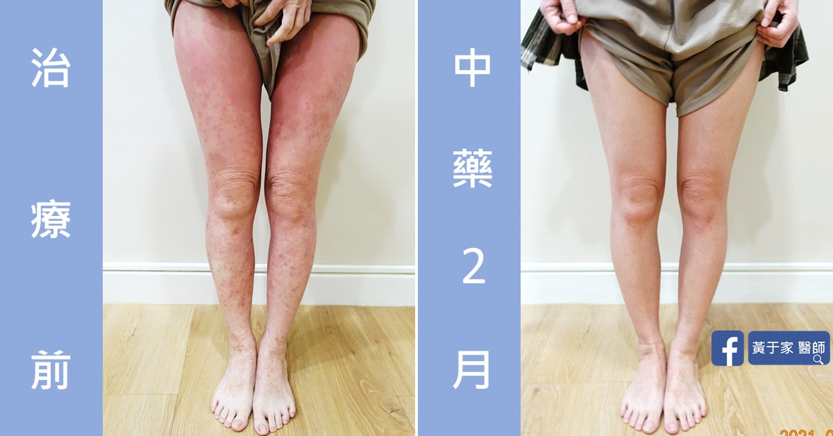 類固醇戒斷患者治療前後皮膚外觀比對（2）