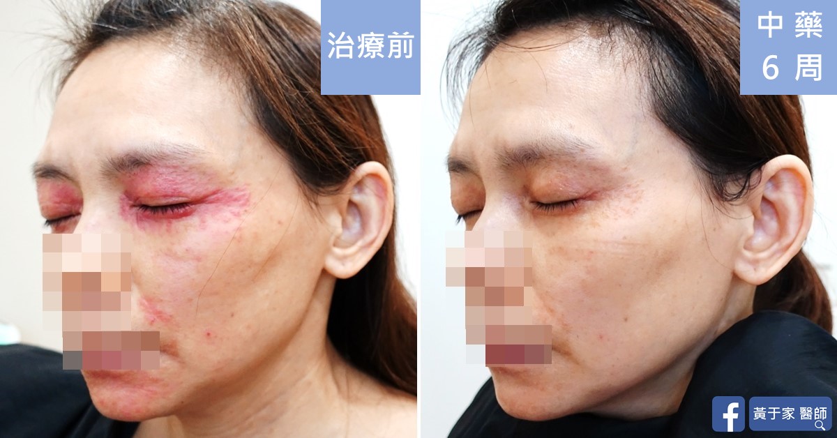 類固醇戒斷患者治療前後皮膚外觀比對