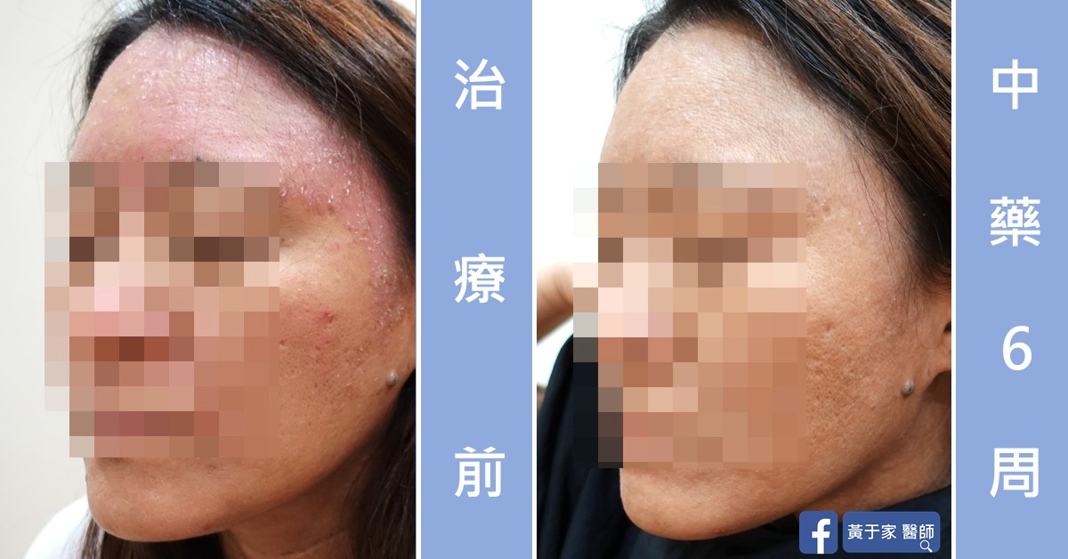 同一位患者左側臉的比對,左標示「治療前」,額頭與臉頰泛紅脫屑;右標示「中藥 6 周」