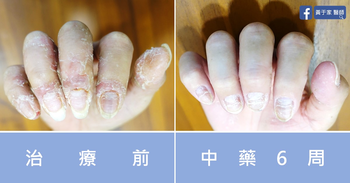 手部濕疹患者治療前後皮膚外觀比對