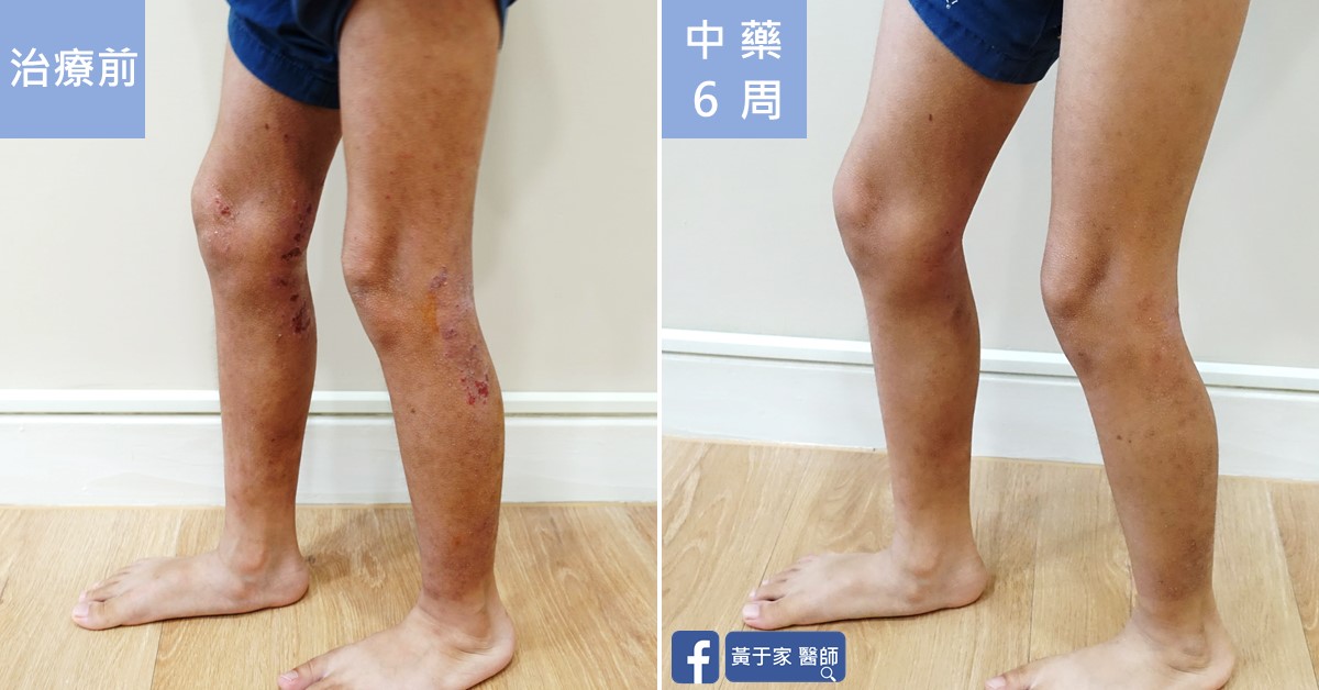 同一位小患者雙腿側面屈膝站姿的比對,左標示「治療前」,膝後可見傷口;右標示「中藥 6 周」