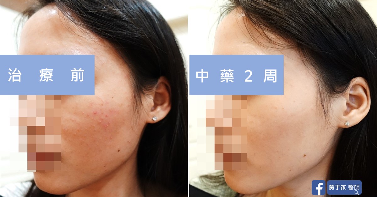同一位患者左側臉的比對,左標示「治療前」,臉頰泛紅與細小丘疹;右標示「中藥 2 周」