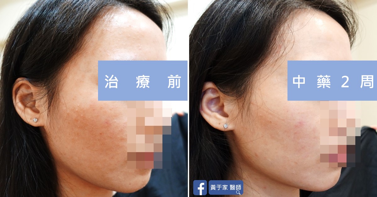 同一位患者右側臉的比對,左標示「治療前」,右標示「中藥 2 周」