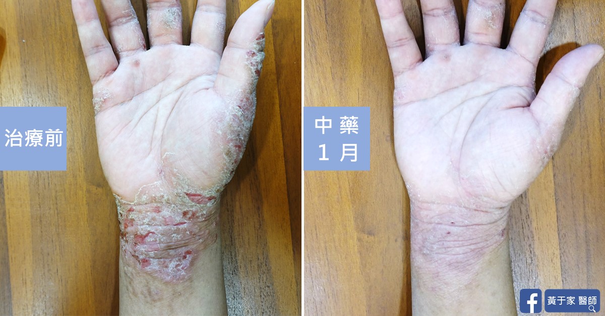 手部濕疹患者治療前後皮膚外觀比對