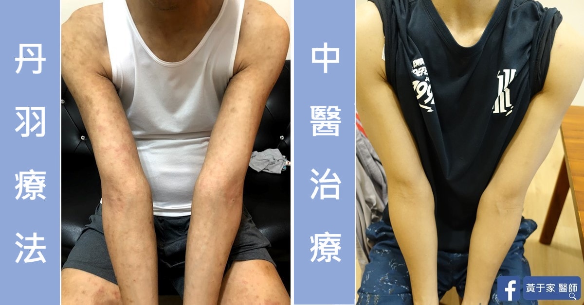 同一位患者雙臂的比對,左標示「丹羽療法」,右標示「中醫治療」