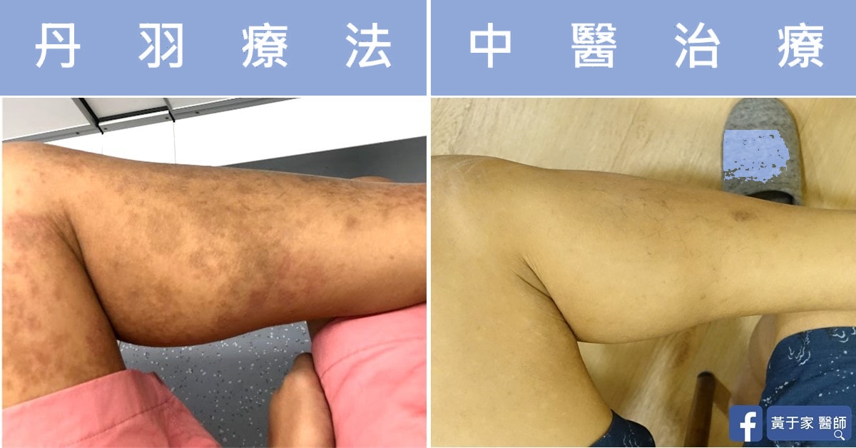 同一位患者腿部的比對,左標示「丹羽療法」,右標示「中醫治療」