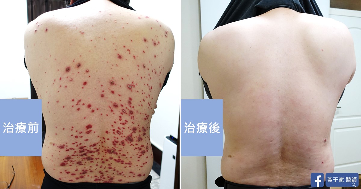 乾癬患者治療前後皮膚外觀比對（1）