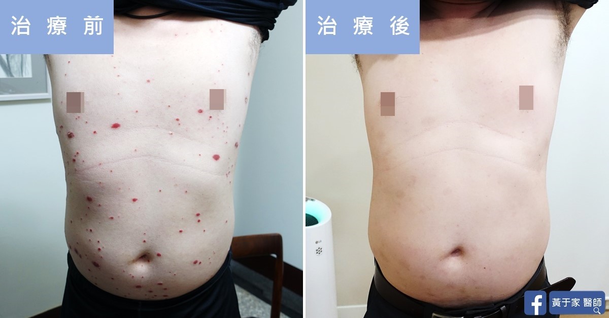 乾癬患者治療前後皮膚外觀比對（2）