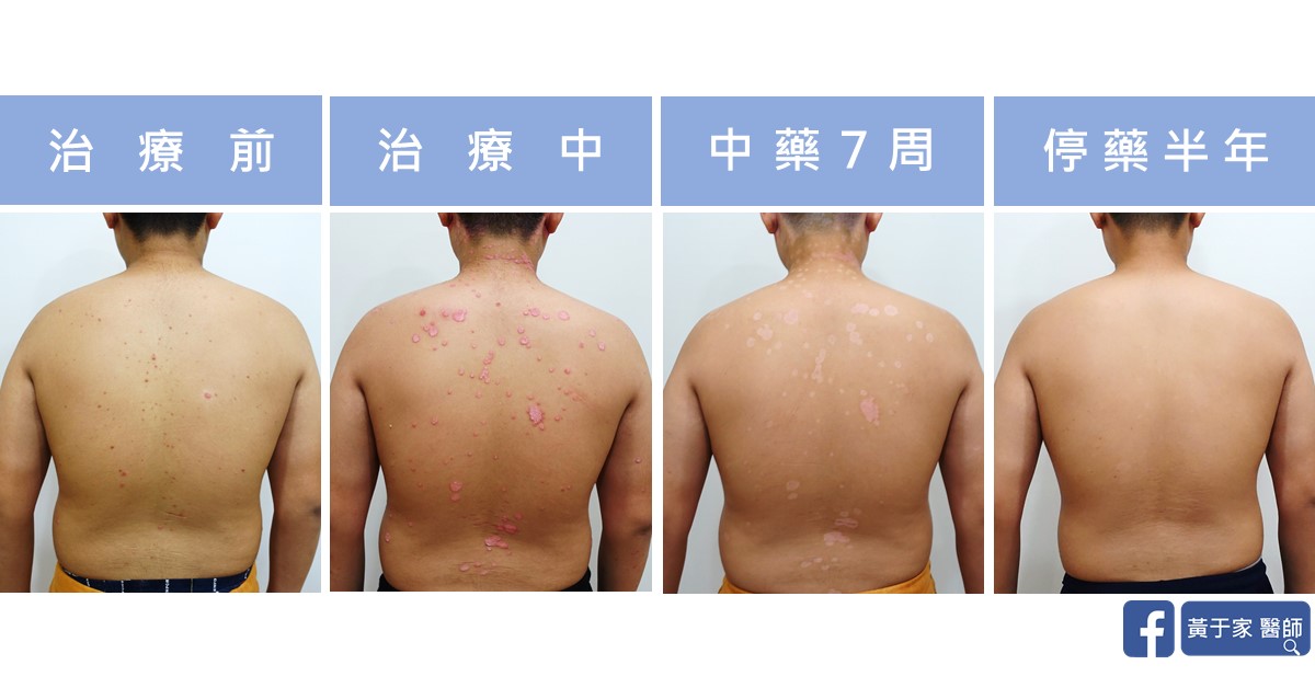 乾癬患者治療前後皮膚外觀比對