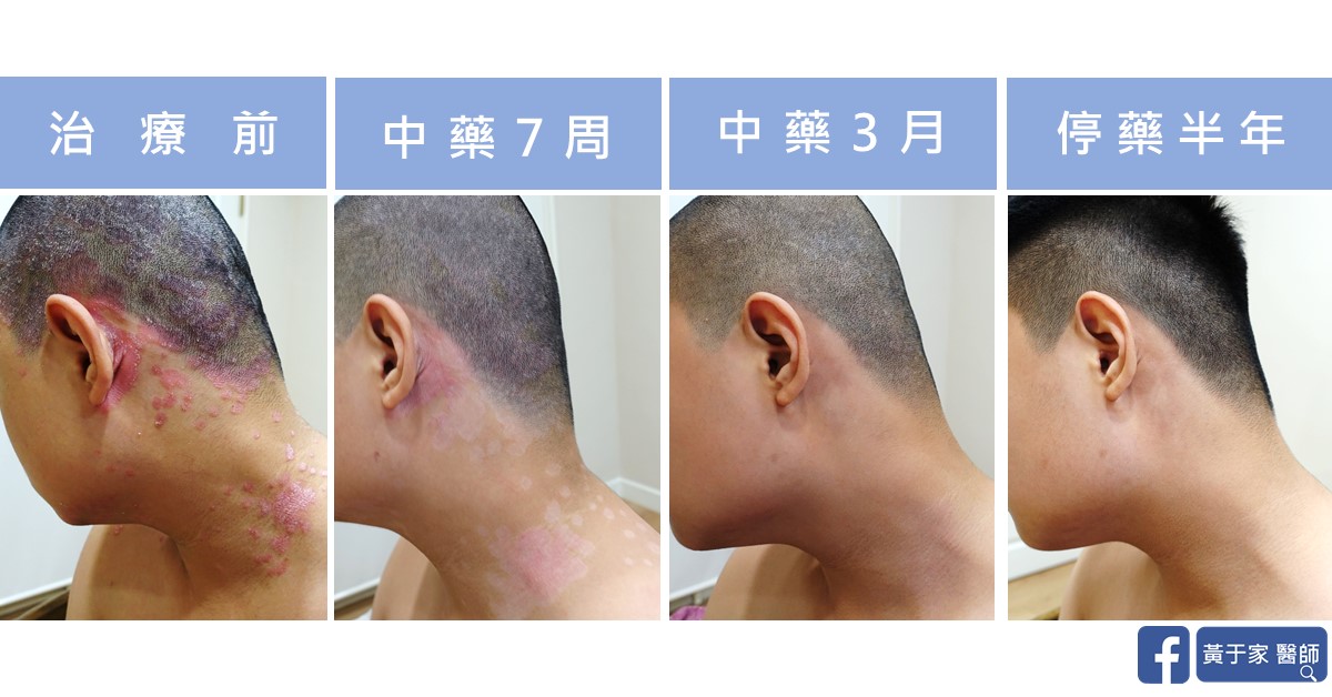 乾癬患者治療前後皮膚外觀比對（1）