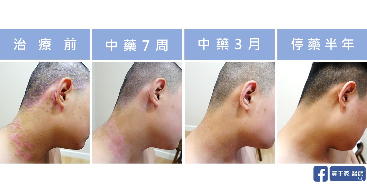 乾癬患者治療前後皮膚外觀比對（2）