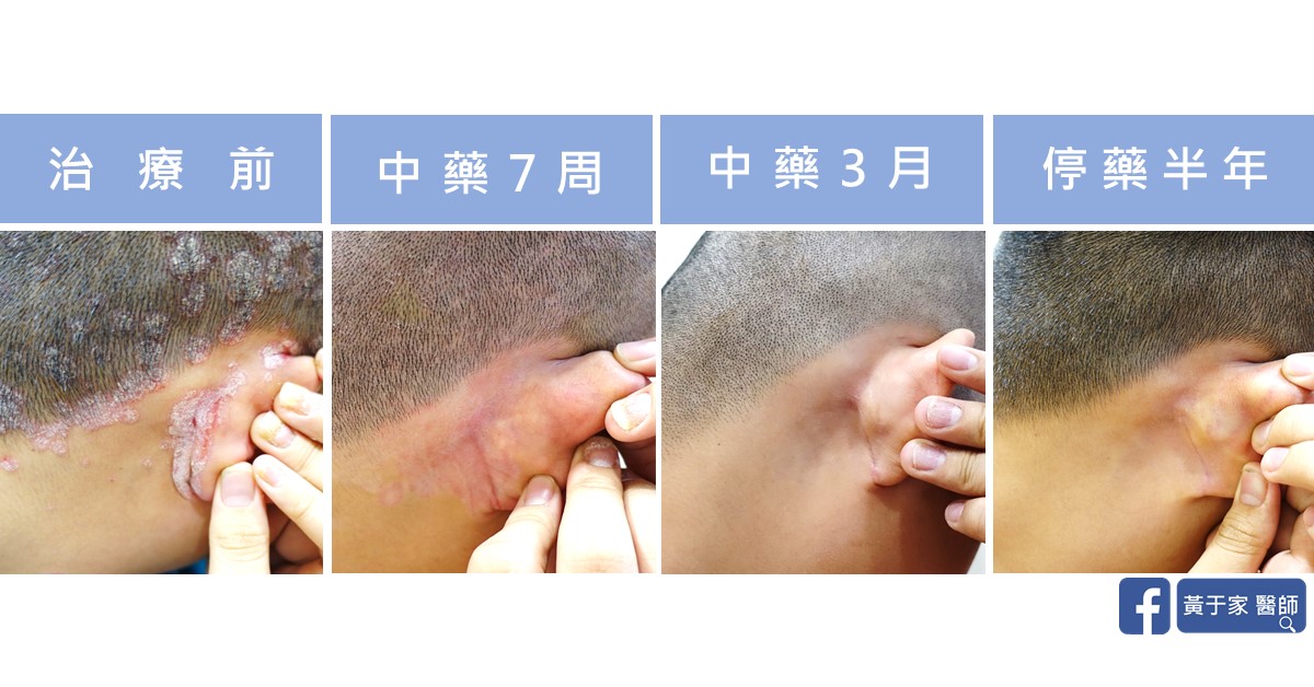 乾癬患者治療前後皮膚外觀比對（3）